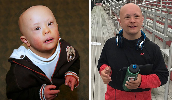 Alopecia in kids discount
