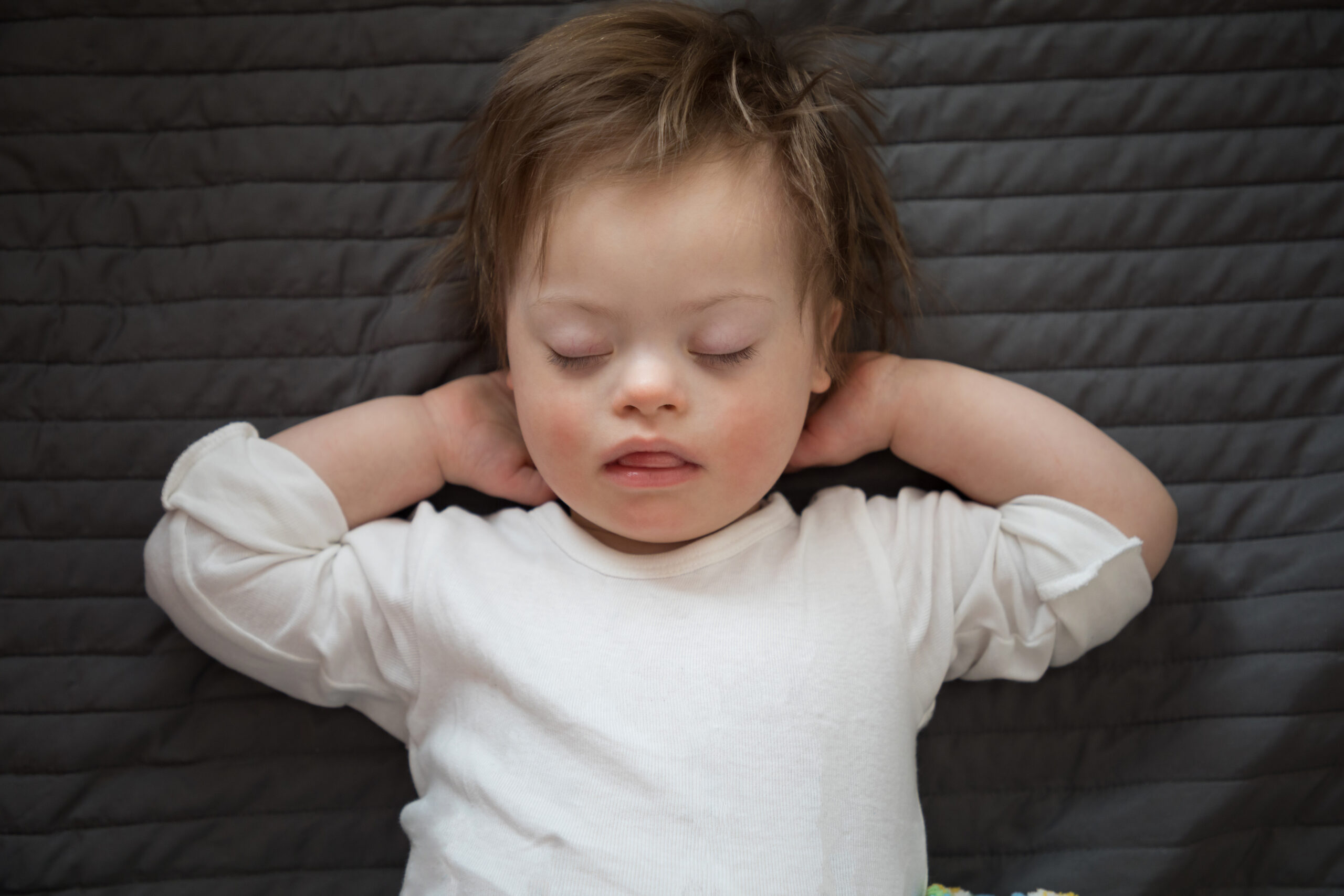 Sleep Apnea Across the Lifespan in People with Down Syndrome